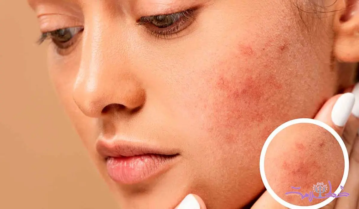 چه غذاهایی باعث التهاب پوست می شود؟ + توصیه های تغذیه ای برای پوست سالم