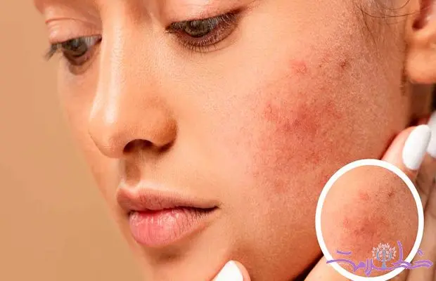 چه غذاهایی باعث التهاب پوست می شود؟ + توصیه های تغذیه ای برای پوست سالم