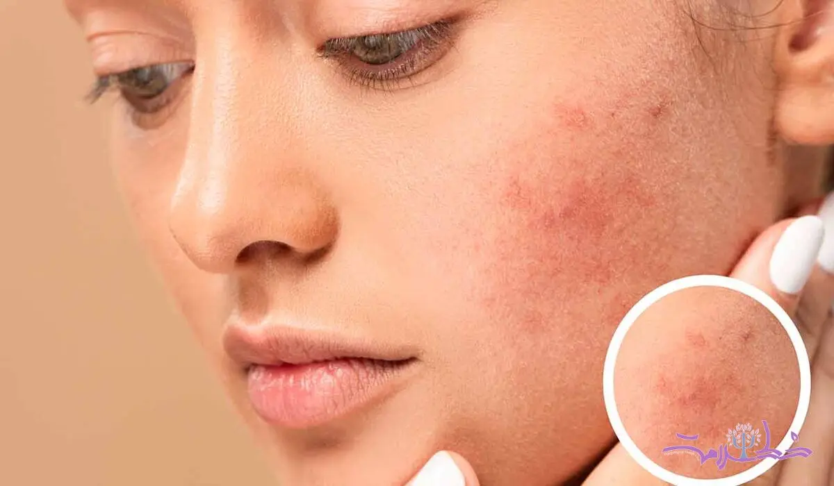 چه غذاهایی باعث التهاب پوست می شود؟ + توصیه های تغذیه ای برای پوست سالم