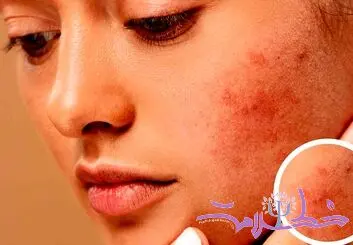 چه غذاهایی باعث التهاب پوست می شود؟ + توصیه های تغذیه ای برای پوست سالم