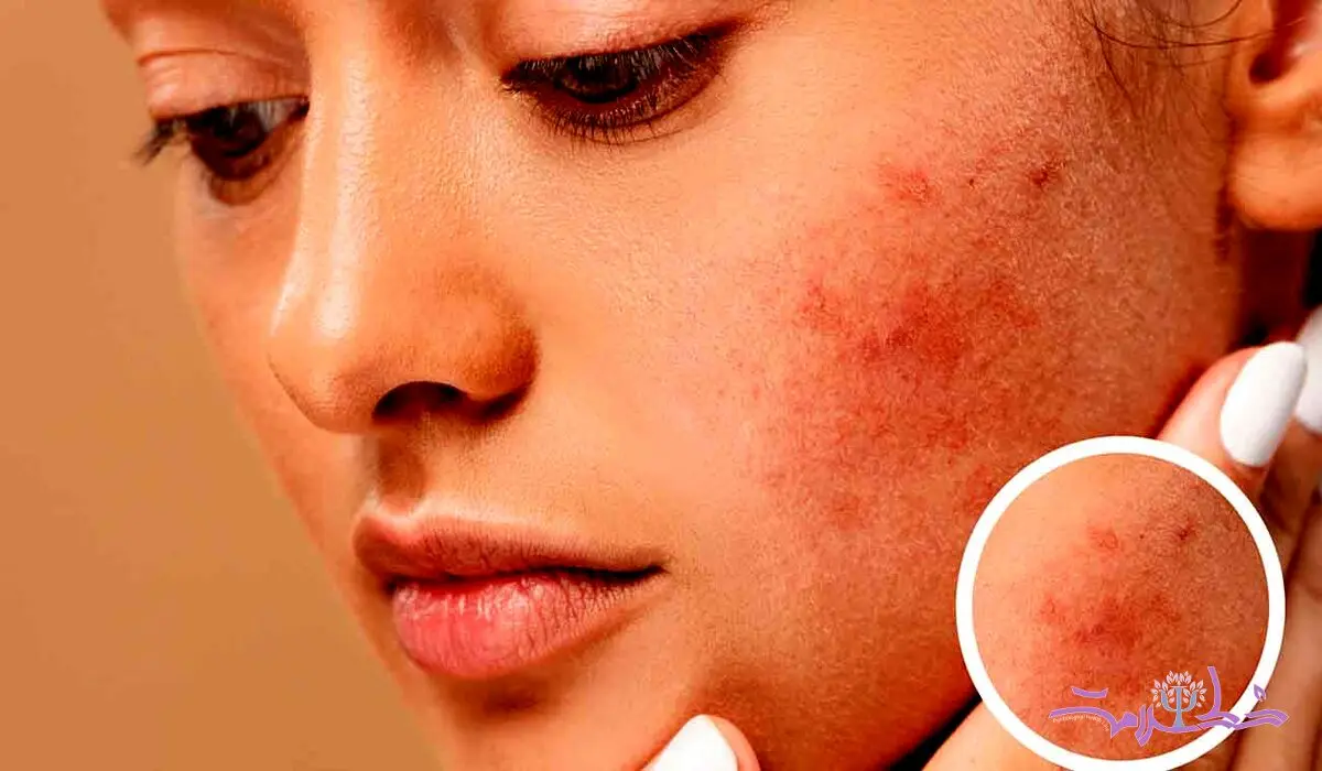 چه غذاهایی باعث التهاب پوست می شود؟ + توصیه های تغذیه ای برای پوست سالم