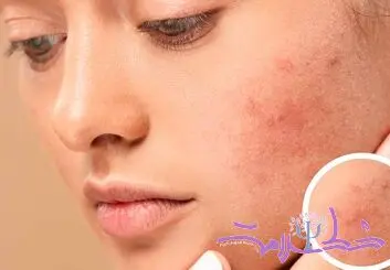 چه غذاهایی باعث التهاب پوست می شود؟ + توصیه های تغذیه ای برای پوست سالم