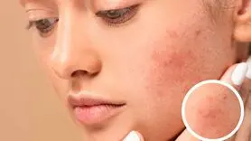 چه غذاهایی باعث التهاب پوست می شود؟ + توصیه های تغذیه ای برای پوست سالم