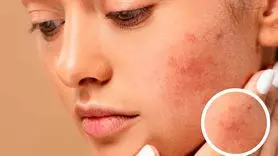 چه غذاهایی باعث التهاب پوست می شود؟ + توصیه های تغذیه ای برای پوست سالم