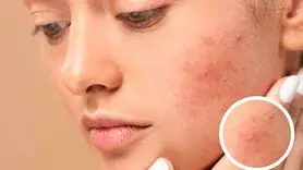 چه غذاهایی باعث التهاب پوست می شود؟ + توصیه های تغذیه ای برای پوست سالم