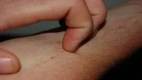  این موجودات ریز عامل خارش شدید شبانه بدن 