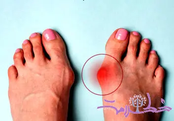 آیا کفش‌های شما به پاهای‌تان آسیب می‌زنند؟ +جراح برتر بهترین راه‌حل‌ها برای درمان بونیون را معرفی می‌کند