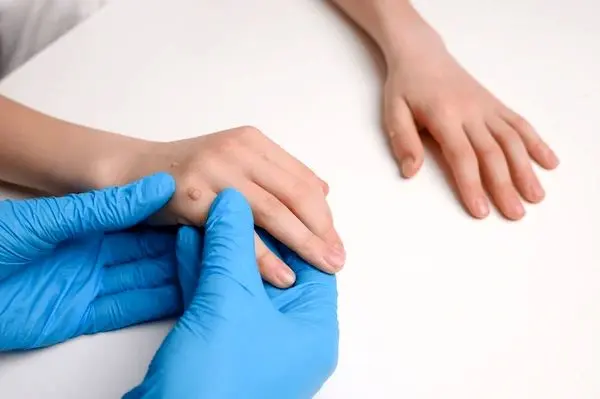 اگر زگیل تناسلی داشتیم چه کار کنیم؟