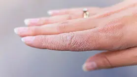 کرم طبیعی خانگی برای رفع خشکی پوست 