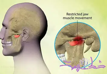 این بیماری فک را قفل کرده و می کشد