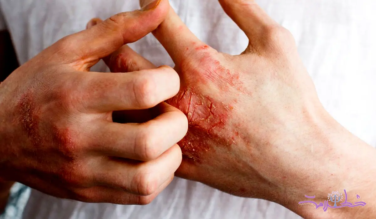 نئوتادین (دس لوراتادین) چیست؟ + تداخلات دارویی و تاثیر آن بر میل جنسی