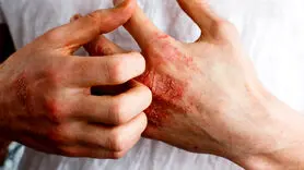 نئوتادین (دس لوراتادین) چیست؟ + تداخلات دارویی و تاثیر آن بر میل جنسی