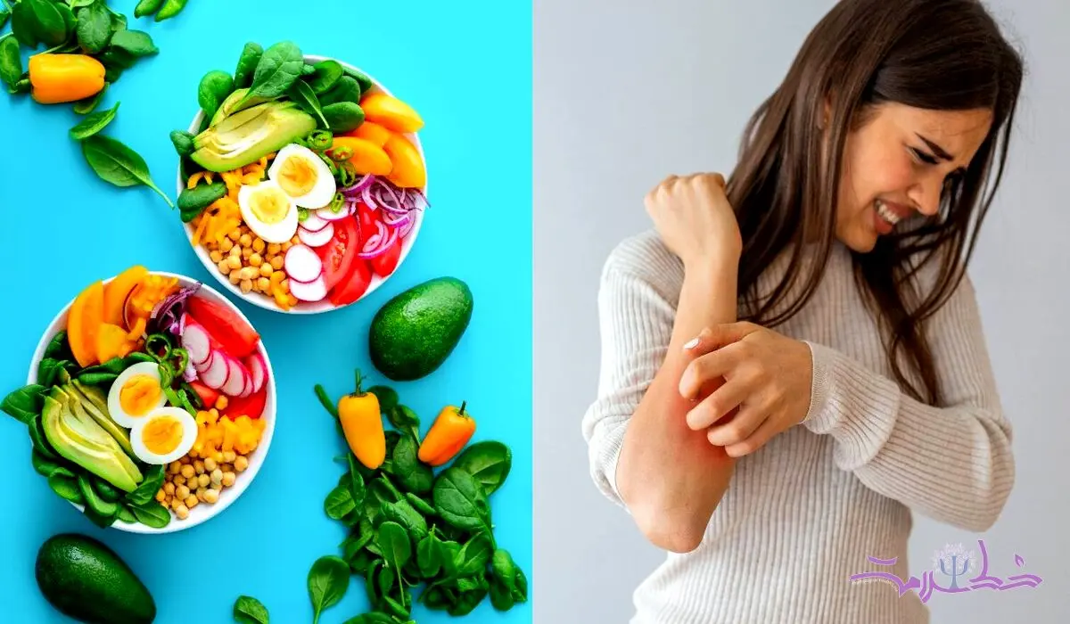 رژیم غذایی مناسب برای پسوریازیس: چه بخوریم و چگونه از تشدید آن جلوگیری کنیم؟
