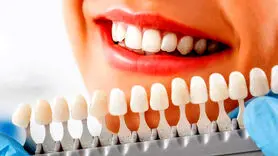 آیا سفید کردن دندان‌ها برای سلامت روان شما مفید است؟