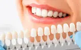 آیا سفید کردن دندان‌ها برای سلامت روان شما مفید است؟