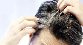 این 4 ویتامین را کم داشته باشید ریزش مو و سفیدی حتمی است