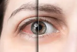  سندرم شوگرن چیست؟