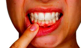 چگونه بیماری لثه بر سلامت کلی بدن تأثیر می‌گذارد؟