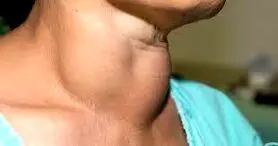 گواتر چه زمانی اتفاق می یافد؟ + علائم و درمان