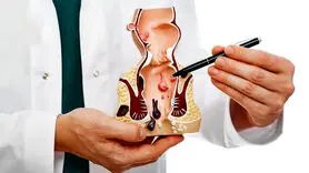 علل و درمان هموروئید از دیدگاه طب سنتی