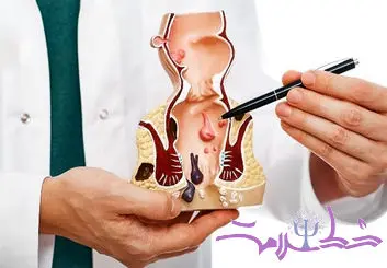 علل و درمان هموروئید از دیدگاه طب سنتی