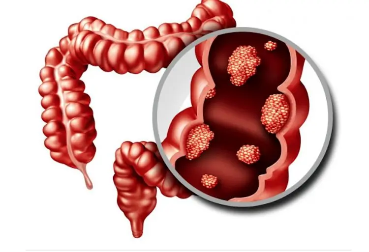 سرطان روده بزرگ؛ علت، نشانه‌ها و راه‌های درمان آن