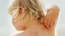 اوتیسم  و این بیماری پوستی سایه به سایه می آیند+ این نکته را جدی بگیرید