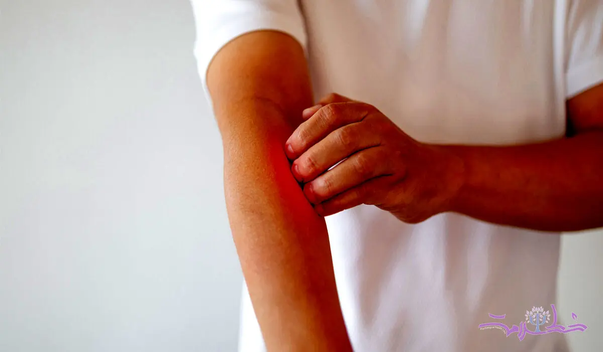 استرس چگونه باعث خارش پوست می‌شود و چگونه از آن پیشگیری کنیم؟