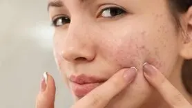 از بین بردن جوش‌های صورت و آکنه به 10 شیوه