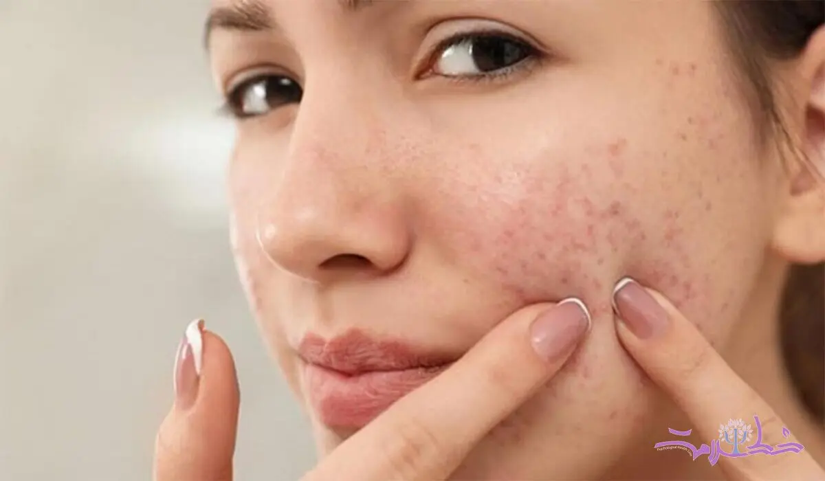 از بین بردن جوش‌های صورت و آکنه به 10 شیوه