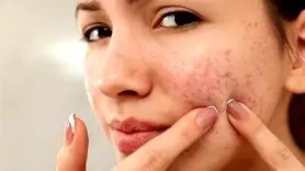 از بین بردن جوش‌های صورت و آکنه به 10 شیوه