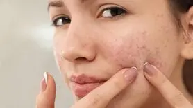 از بین بردن جوش‌های صورت و آکنه به 10 شیوه