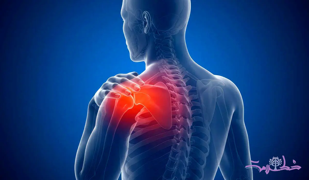 شانه منجمد چیست؟ علل، علائم و بهترین روش های درمان