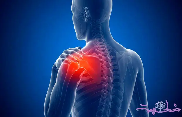 شانه منجمد چیست؟ علل، علائم و بهترین روش های درمان