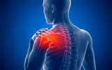 شانه منجمد چیست؟ علل، علائم و بهترین روش های درمان