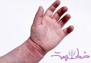 آیا اگزما خطر بیماری قلبی را افزایش می دهد؟