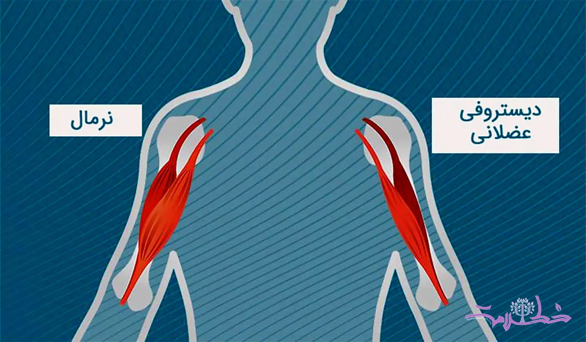 دیستروفی عضلانی چند نوع است و چگونه می توان درمان کرد؟
