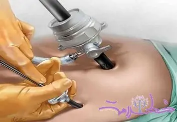 جزییات مرگ دانشجوی مهندسی در اتاق عمل/ دختر۱۴۰ کیلویی چطور جان باخت؟