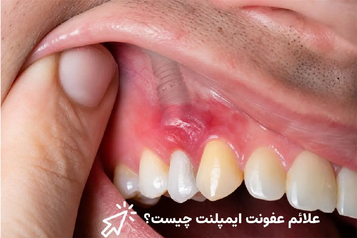 کمپرس سرد برای رفع ورم و التهاب ایمپلنت و و علائم عفونت آن