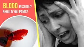 خونریزی از مدفوع و تاثیر آن بر اضطراب، افسردگی و خستگی ذهنی