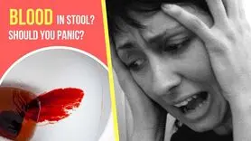 خونریزی از مدفوع و تاثیر آن بر اضطراب، افسردگی و خستگی ذهنی