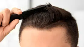 بعد از کاشت مو این کارها را بکنید دوباره بی مو می شوید