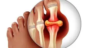 همه چیز درباره نقرس: چه کسانی در معرض خطر این بیماری هستند؟
