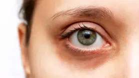 کمبود 5 ویتامین علت سیاهی دور چشم است