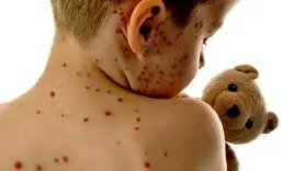 به این 2 علت آبله مرغان به خانه ایرانی ها هجوم آورده است