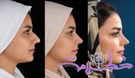 بینی گوشتی بعد از عمل برمی‌گردد؟ 7 نکته مهم پیش از انتخاب جراح