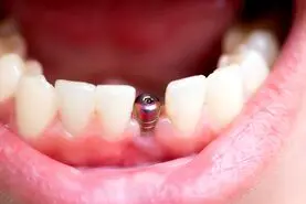 همه چیز درباره ایمپلنت دندان