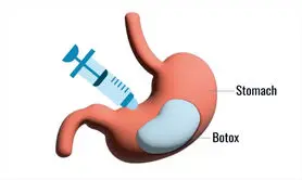 آیا بوتاکس معده واقعا باعث لاغری می شود؟