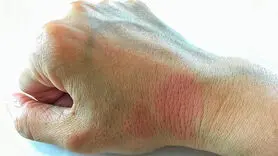 بیماری لوپوس چیست و چه کسانی به آن مبتلا می‌شوند؟