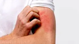 خارش پوست بدن به چه علتی است؟+درمان